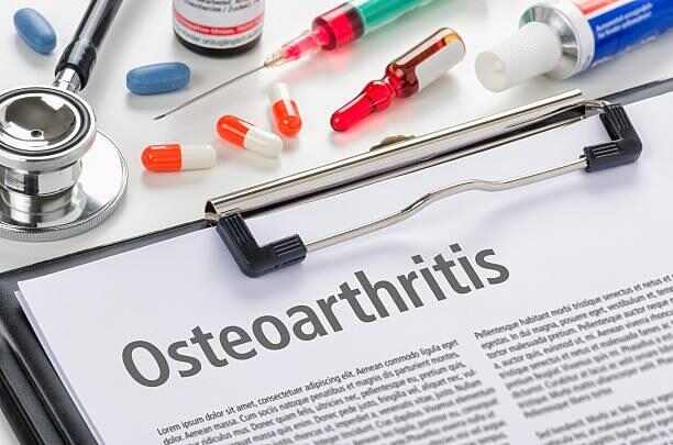 Stammzellen bei Arthrose: Was Sie 2025 über Chancen und seriöse Anbieter wissen müssen